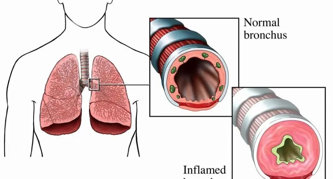 怎么呼吸麻醉常见呼吸系统疾病患者的麻醉_https://www.jmylbn.com_新闻资讯_第4张