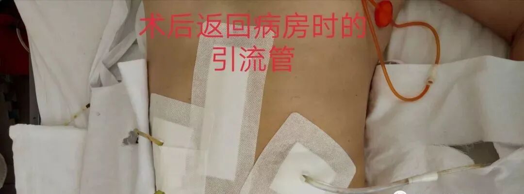 尿管怎么固定学会这7种引流管固定方法，患者术后下床活动不慌张！_https://www.jmylbn.com_新闻资讯_第1张
