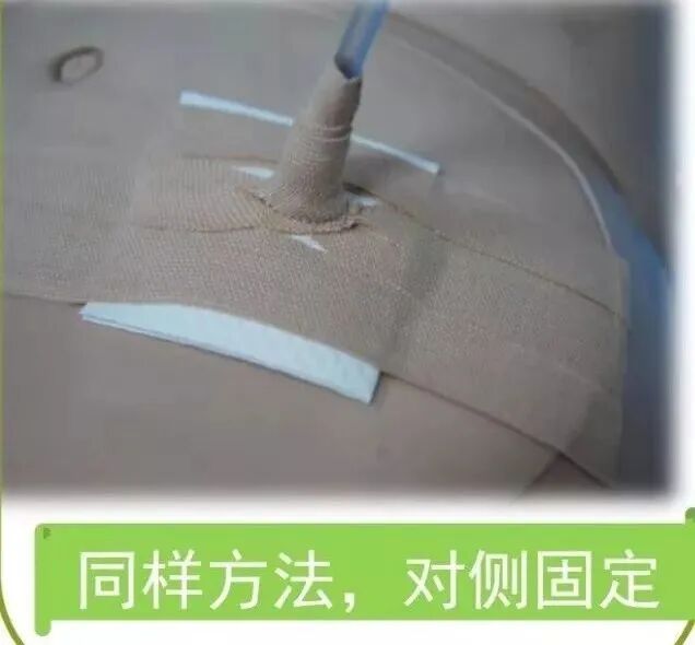 尿管怎么固定学会这7种引流管固定方法，患者术后下床活动不慌张！_https://www.jmylbn.com_新闻资讯_第8张