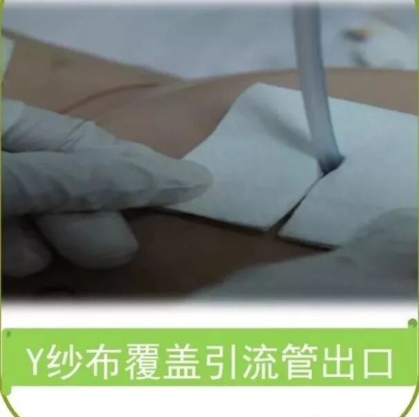 尿管怎么固定学会这7种引流管固定方法，患者术后下床活动不慌张！_https://www.jmylbn.com_新闻资讯_第6张