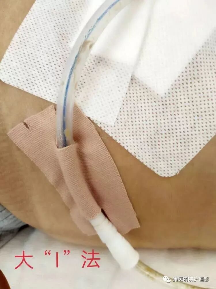 尿管怎么固定学会这7种引流管固定方法，患者术后下床活动不慌张！_https://www.jmylbn.com_新闻资讯_第3张