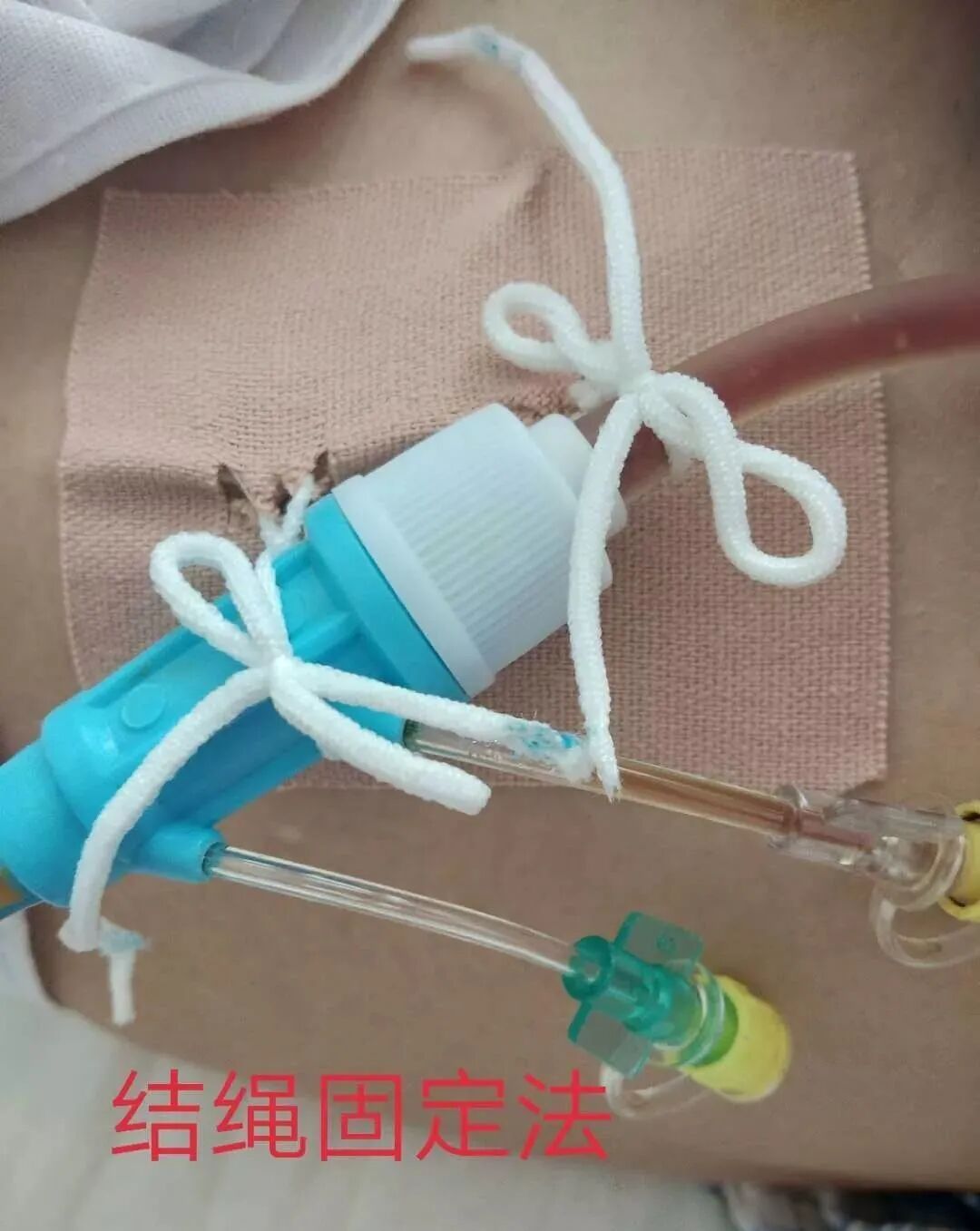 尿管怎么固定学会这7种引流管固定方法，患者术后下床活动不慌张！_https://www.jmylbn.com_新闻资讯_第5张