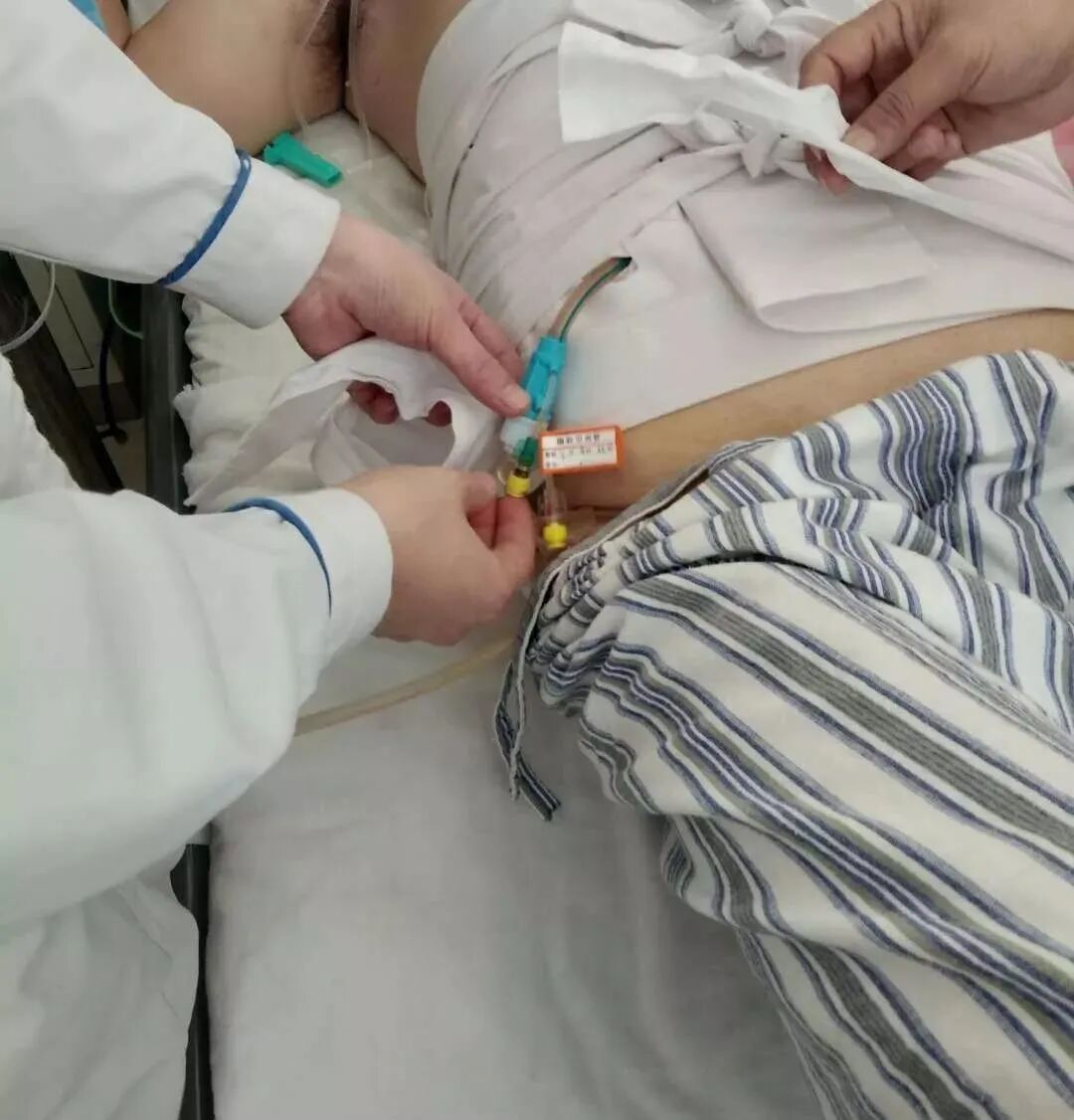 尿管怎么固定学会这7种引流管固定方法，患者术后下床活动不慌张！_https://www.jmylbn.com_新闻资讯_第10张