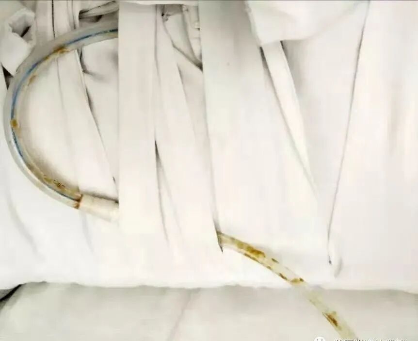 尿管怎么固定学会这7种引流管固定方法，患者术后下床活动不慌张！_https://www.jmylbn.com_新闻资讯_第9张