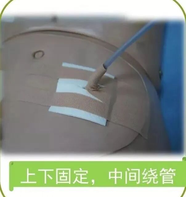 尿管怎么固定学会这7种引流管固定方法，患者术后下床活动不慌张！_https://www.jmylbn.com_新闻资讯_第7张