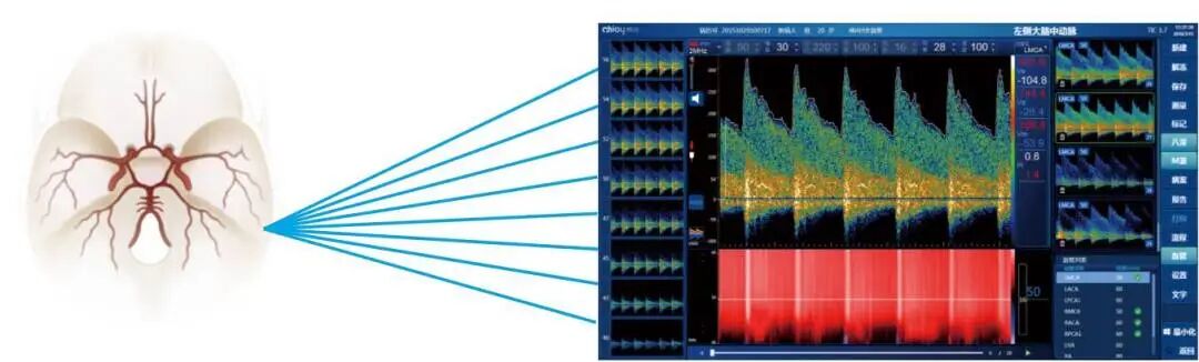 tcd2000怎么样【体检新动态】经颅多普勒在健康体检中的应用_https://www.jmylbn.com_新闻资讯_第3张