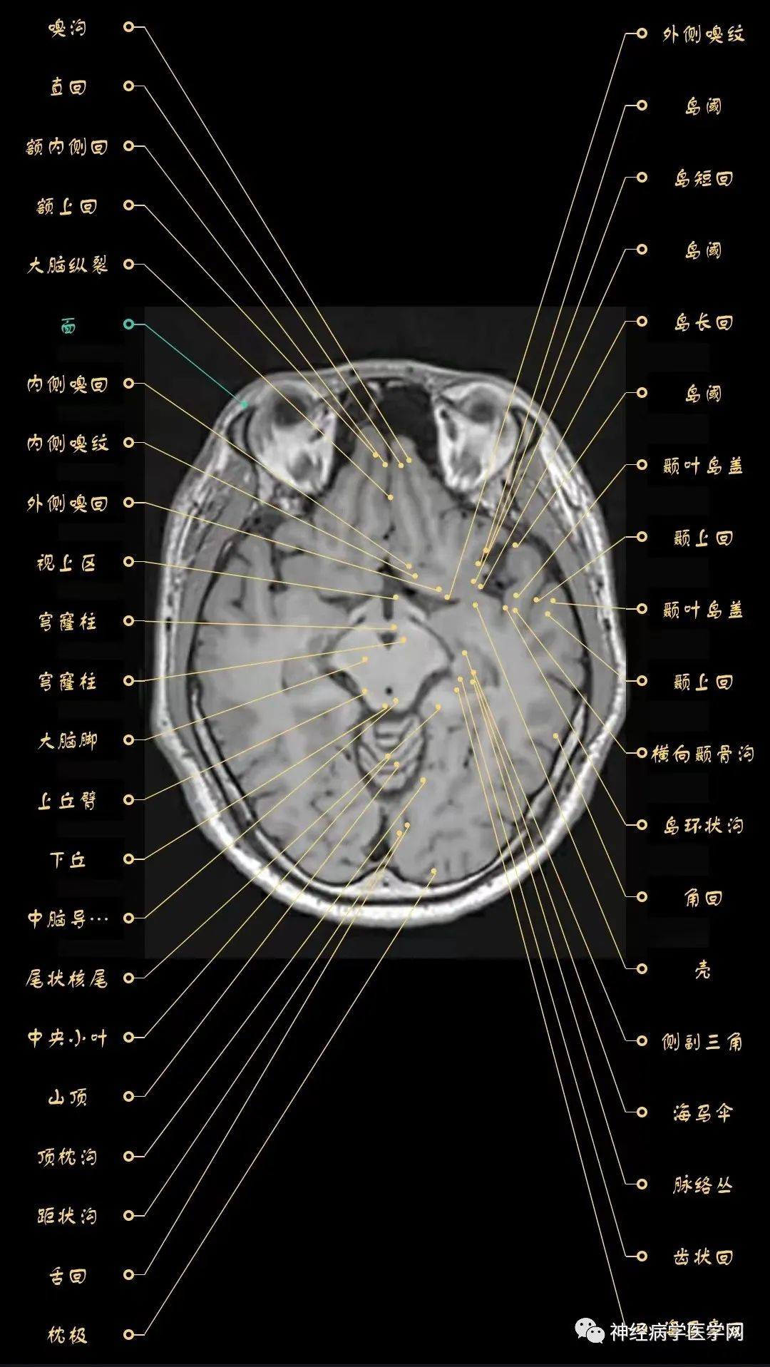 高清颅脑mri最全轴位影像解剖