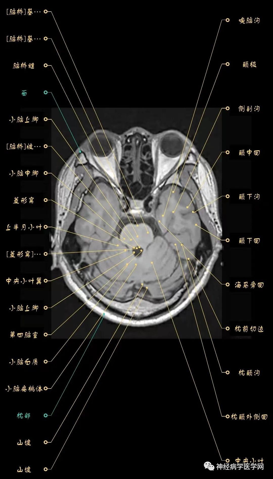 高清颅脑mri最全轴位影像解剖