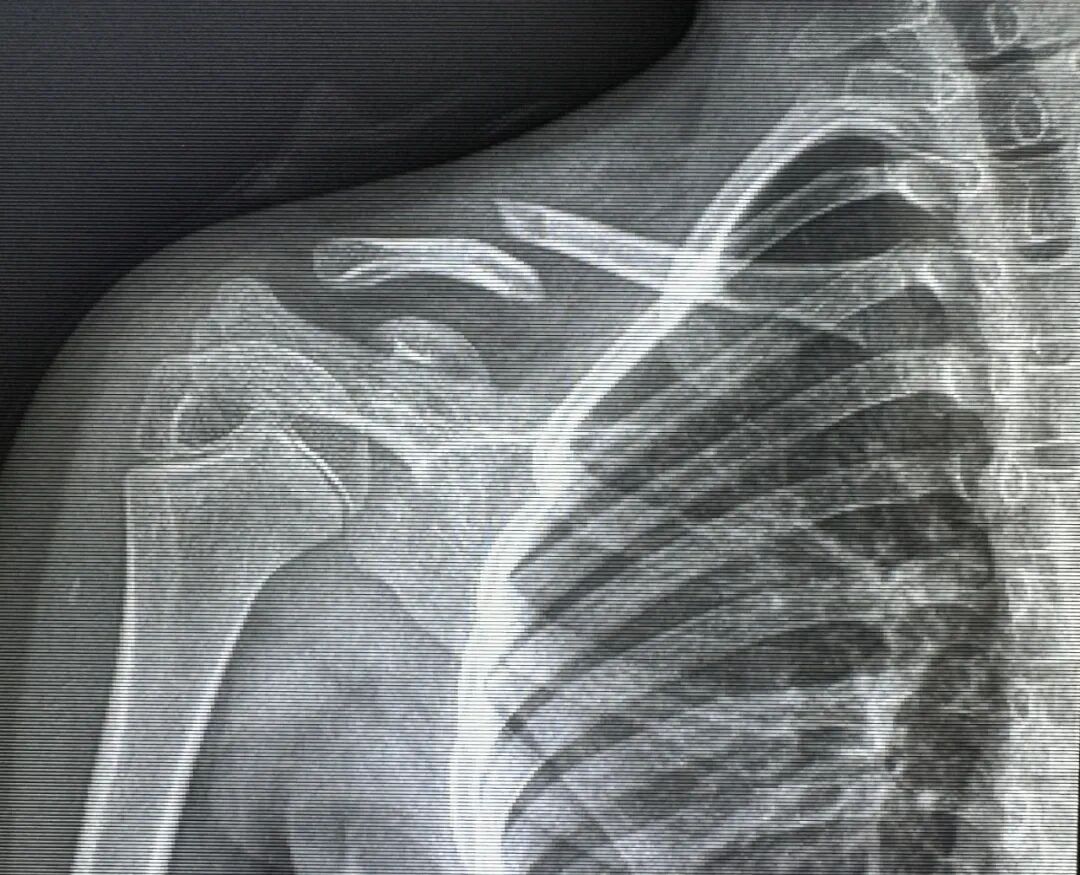 【卓越医疗】微创技术治疗青少年锁骨骨折——不开刀，“针”不错！