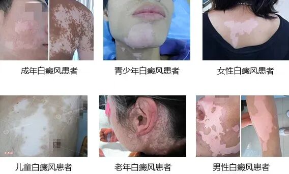 成都白癜风最好医院