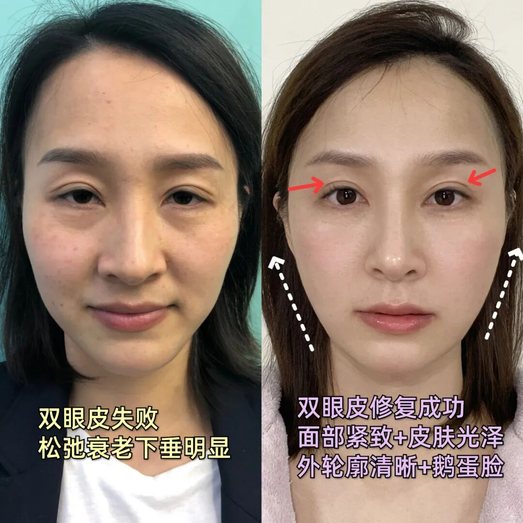 女明星扎堆做的轮廓固定眼周抗衰，真的有那么好吗？