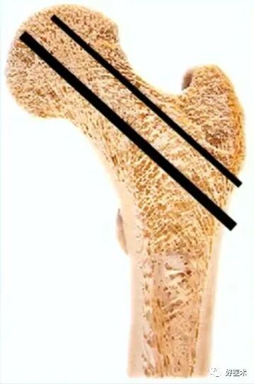 手把手教程：打牢转子间髓内钉，技巧在这！