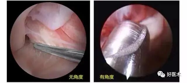 关节镜配套哪些关节镜技术速成诀窍_https://www.jmylbn.com_新闻资讯_第13张