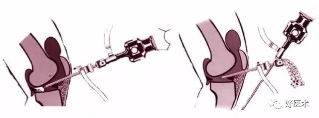 关节镜配套哪些关节镜技术速成诀窍_https://www.jmylbn.com_新闻资讯_第19张