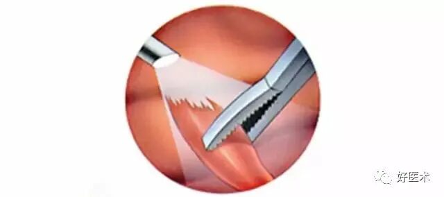 关节镜配套哪些关节镜技术速成诀窍_https://www.jmylbn.com_新闻资讯_第15张