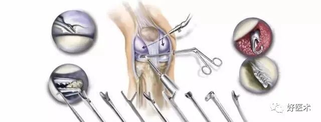 关节镜配套哪些关节镜技术速成诀窍_https://www.jmylbn.com_新闻资讯_第28张
