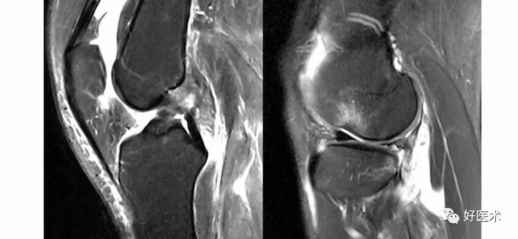 干货：高清动图学前交叉韧带MRI诊断，经典珍藏版！