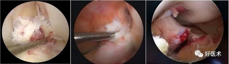 干货：高清动图学前交叉韧带MRI诊断，经典珍藏版！