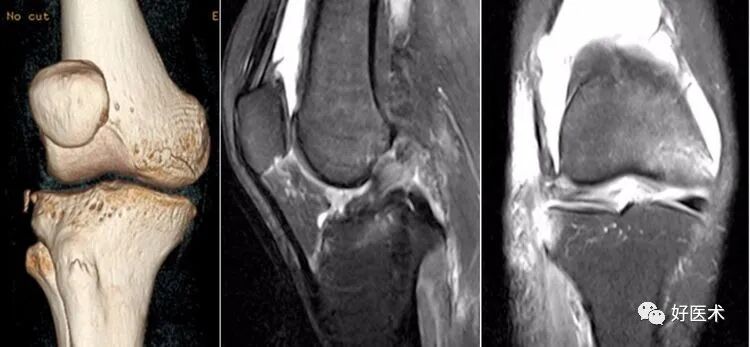 干货：高清动图学前交叉韧带MRI诊断，经典珍藏版！