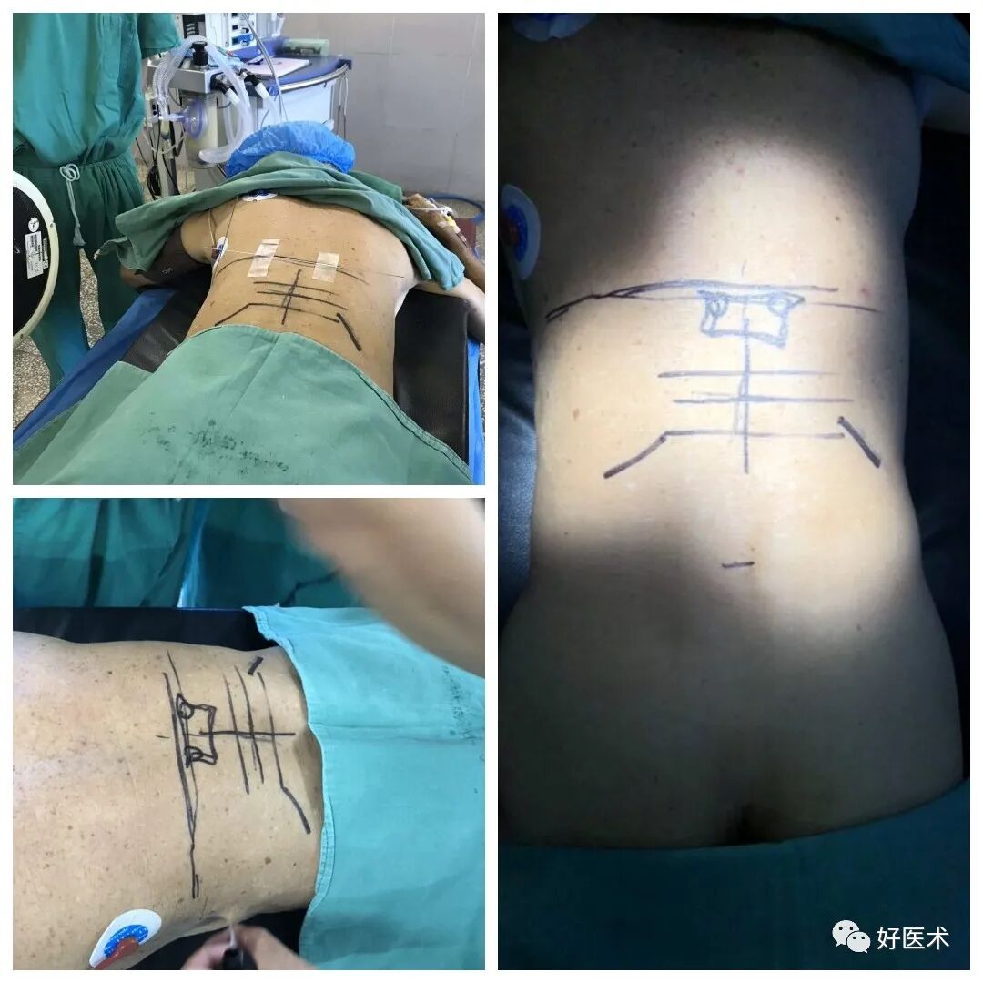 pvp手术怎么麻醉早读 ｜ 牢固掌握椎体成形术要领，看这篇文章就够了！_https://www.jmylbn.com_新闻资讯_第4张