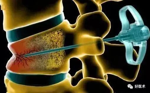 pvp手术怎么麻醉早读 ｜ 牢固掌握椎体成形术要领，看这篇文章就够了！_https://www.jmylbn.com_新闻资讯_第9张