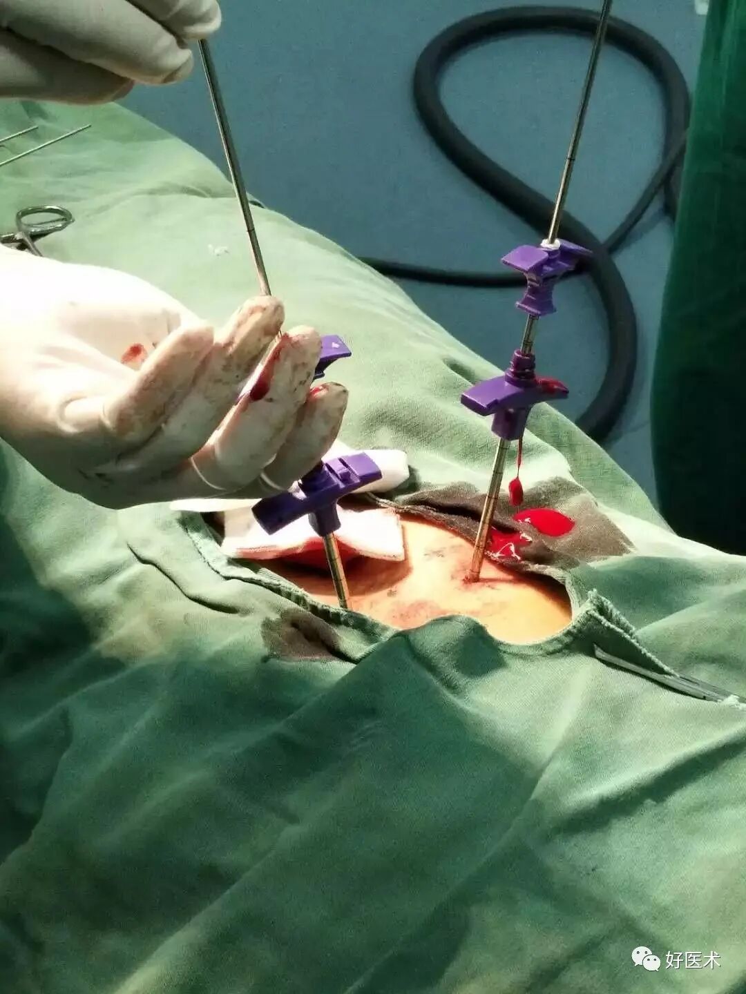 pvp手术怎么麻醉早读 ｜ 牢固掌握椎体成形术要领，看这篇文章就够了！_https://www.jmylbn.com_新闻资讯_第10张