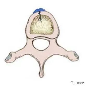 pvp手术怎么麻醉早读 ｜ 牢固掌握椎体成形术要领，看这篇文章就够了！_https://www.jmylbn.com_新闻资讯_第2张