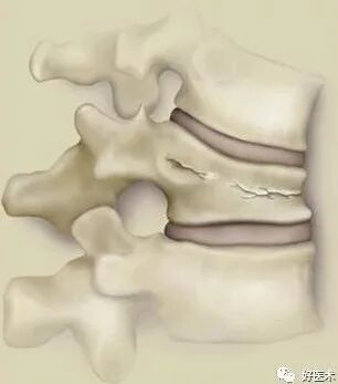 pvp手术怎么麻醉早读 ｜ 牢固掌握椎体成形术要领，看这篇文章就够了！_https://www.jmylbn.com_新闻资讯_第3张