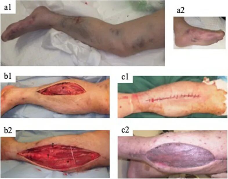 ​四室告急！因树木砸伤导致多部位骨筋膜室综合征，如何治疗？