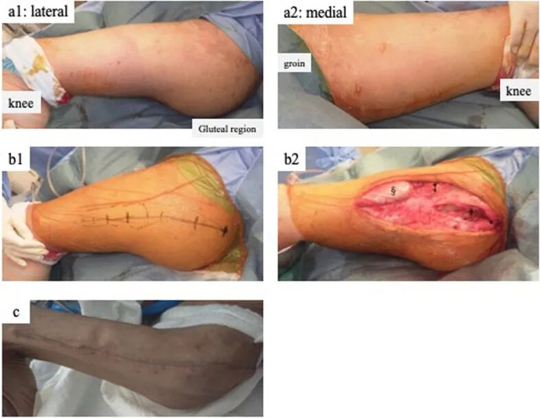 ​四室告急！因树木砸伤导致多部位骨筋膜室综合征，如何治疗？