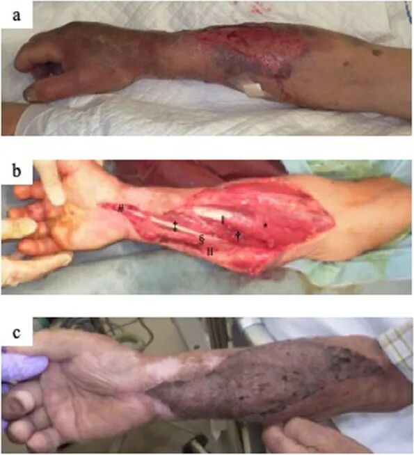 ​四室告急！因树木砸伤导致多部位骨筋膜室综合征，如何治疗？