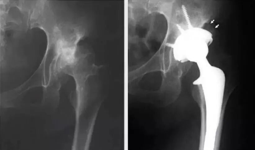 做好初次髋关节置换，这些技巧你掌握了吗？