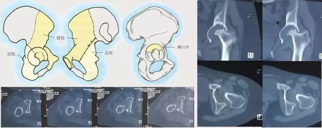 做好初次髋关节置换，这些技巧你掌握了吗？
