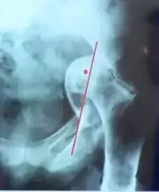 做好初次髋关节置换，这些技巧你掌握了吗？