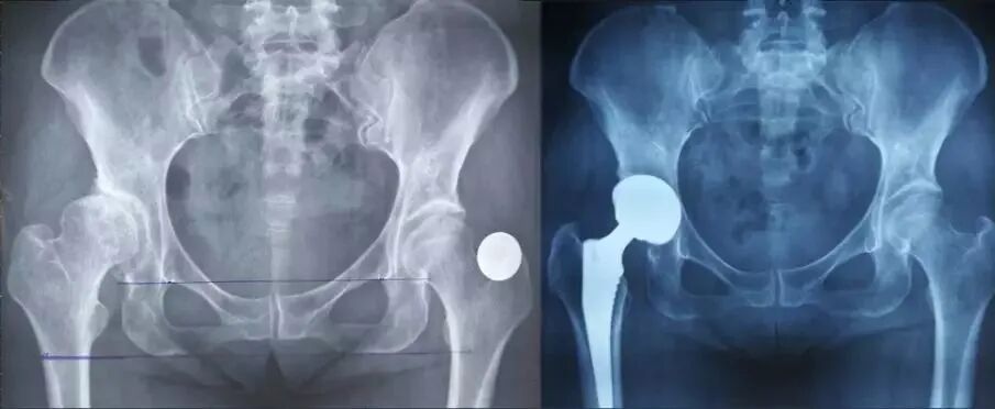 做好初次髋关节置换，这些技巧你掌握了吗？