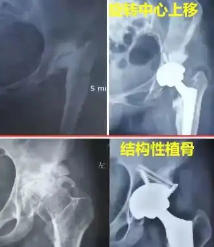 做好初次髋关节置换，这些技巧你掌握了吗？