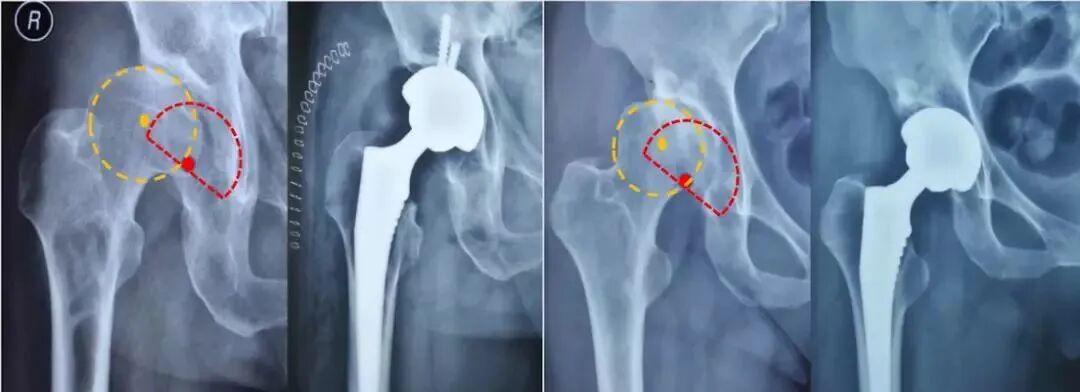 做好初次髋关节置换，这些技巧你掌握了吗？