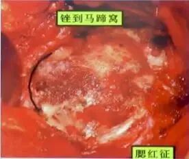 做好初次髋关节置换，这些技巧你掌握了吗？