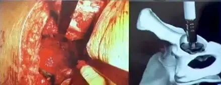 做好初次髋关节置换，这些技巧你掌握了吗？