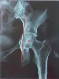 做好初次髋关节置换，这些技巧你掌握了吗？