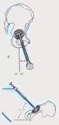 做好初次髋关节置换，这些技巧你掌握了吗？