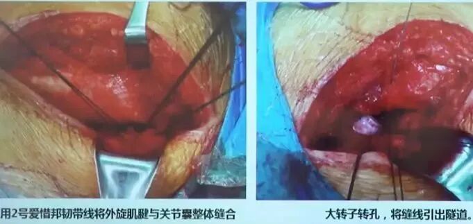 做好初次髋关节置换，这些技巧你掌握了吗？