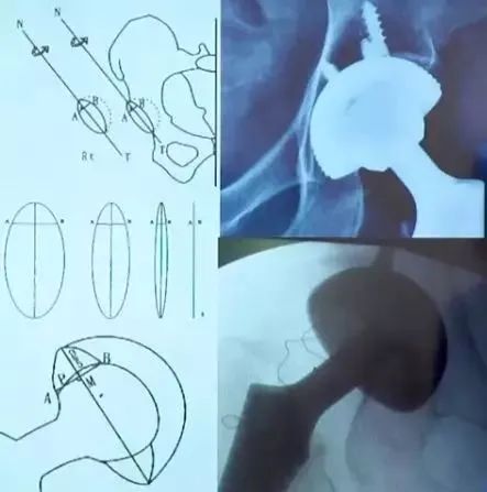 做好初次髋关节置换，这些技巧你掌握了吗？