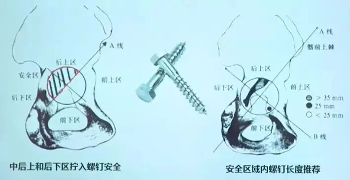 做好初次髋关节置换，这些技巧你掌握了吗？