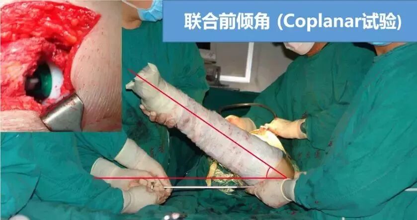 做好初次髋关节置换，这些技巧你掌握了吗？