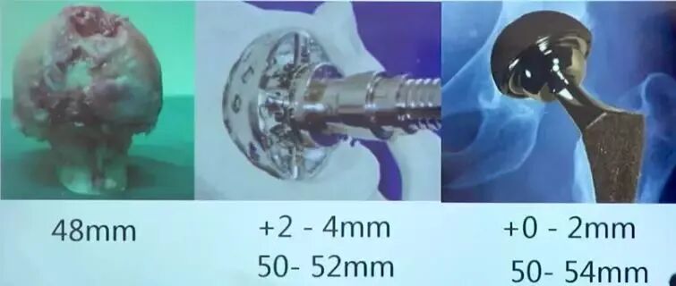 做好初次髋关节置换，这些技巧你掌握了吗？