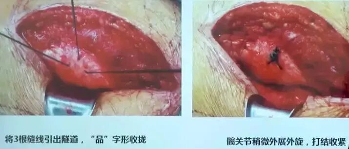 做好初次髋关节置换，这些技巧你掌握了吗？