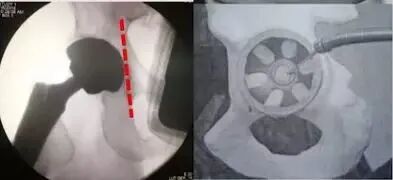 做好初次髋关节置换，这些技巧你掌握了吗？