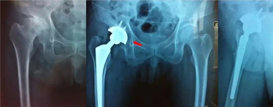 做好初次髋关节置换，这些技巧你掌握了吗？