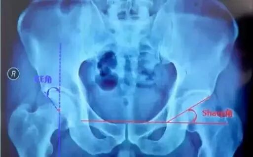 做好初次髋关节置换，这些技巧你掌握了吗？